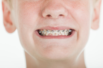 Fototapeta premium Young boy showing off his orthodontic braces