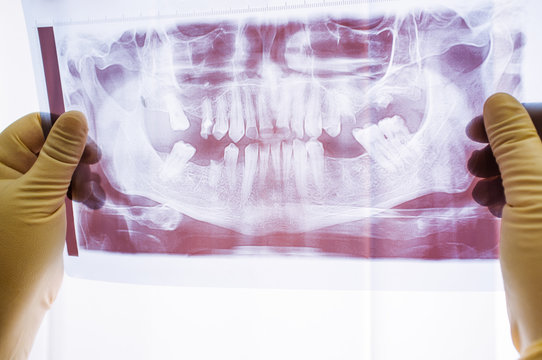Dental x-ray with periodontitis problems, lost teeth and caries. Examination of dental x-ray photo on human jaw with very bad teeth