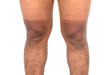 Mountain bike cyclist with two tone level sunburn on his legs
