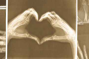 X-ray image of hands making heart symbols.
