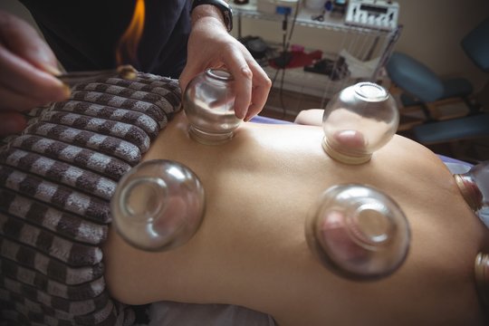 Therapist giving fire cupping therapy to man