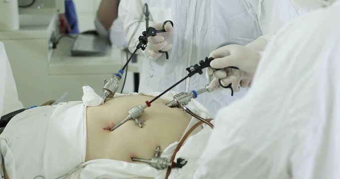 The team of medical specialists conducted laparoscopic surgery.