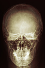Skul head radiology scan by X-rays