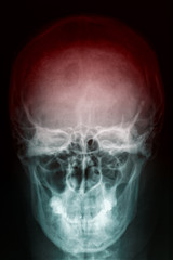 Skull X-ray radiology scan of woman