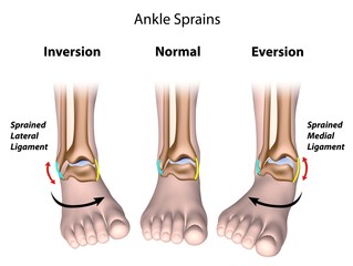 Types of ankle sprains - obrazy, fototapety, plakaty