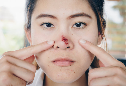The Herpes simplex on asian woman nose, Herpes simplex is a viral disease caused by the herpes simplex virus. Infections are categorized based on the part of the body infected.