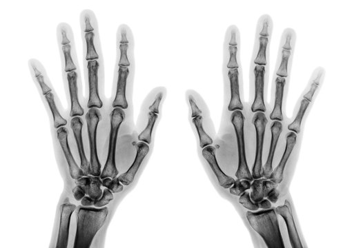 Film x-ray both hand AP show normal human hands on white background ( isolated )