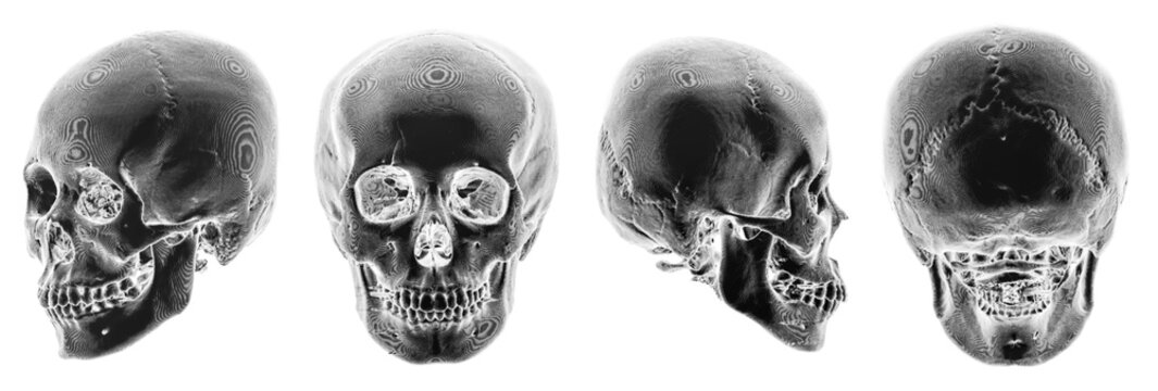 3D CT scan of human skull . Multiple view . Invert color style .