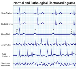 Normal and diseased ecg collection