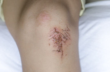 Fototapeta premium Child hurt his knee, an abrasion on the pavement