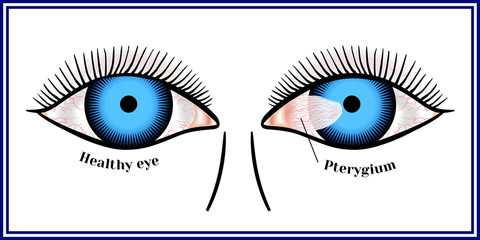 Pterygium. Spreading of the conjunctiva of the eye on the cornea.