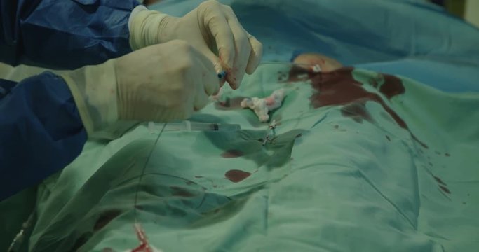 Surgeons inserting a catheter during a Cardiac catheterization in a hospital