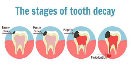 The stages of tooth decay infographic. Dental toothache symbol. Illustration of tooth with caries, pulpitis and periodontitis