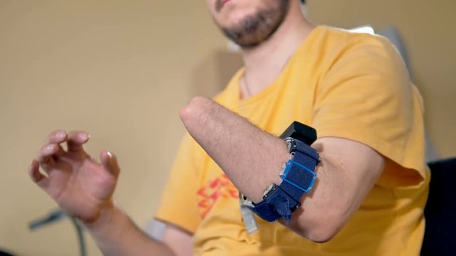 Amputated arm using computer with wireless bionic technology. 4K.