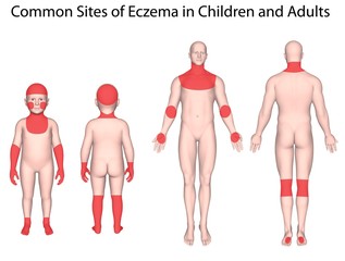Common sites of eczema in adults and children