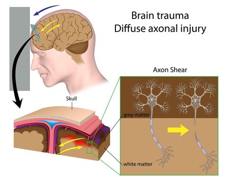 Brain trauma with axon shear