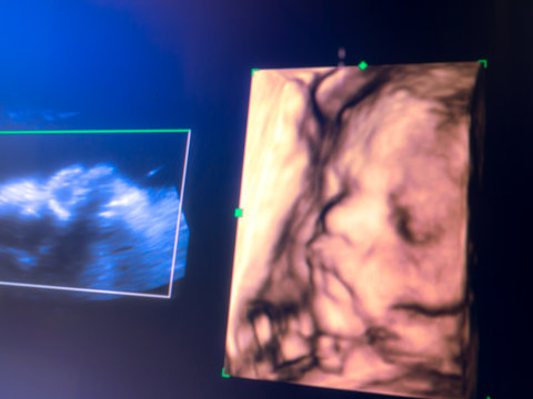 Baby's face 3d picture on 3d ultrasound monitor screen