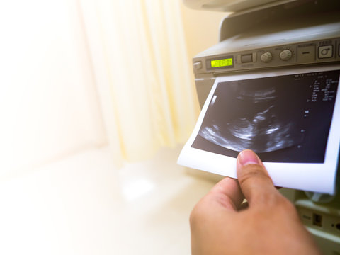 Ultrasound picture of baby printed via ultrasound machine printer in antenatal clinic