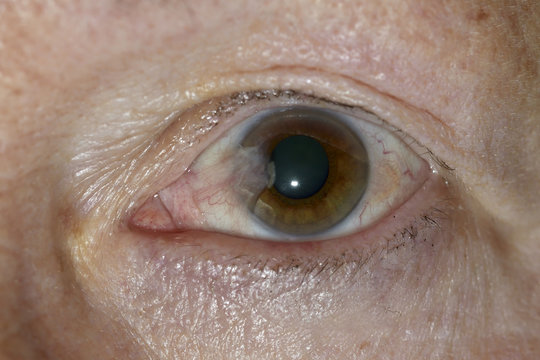 Fl&uuml;gelfellerkrankung an einem Auge