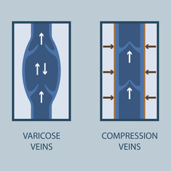 Fototapeta premium Vector illustration of a varicose vein and compression vein. Flat style.