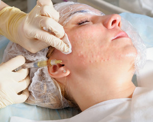 Mesotherapy injections into the face.