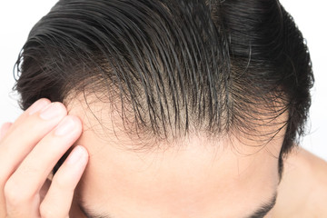 Fototapeta premium Young man serious hair loss problem for health care shampoo and beauty product concept