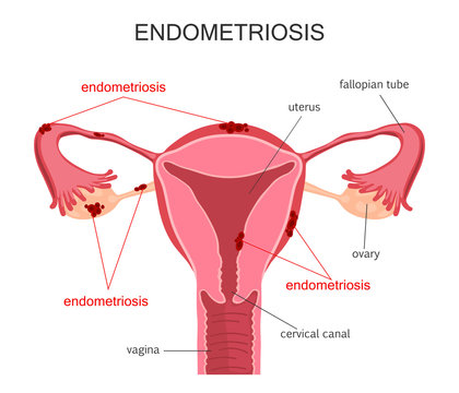 Uterus Endometriosis Diagram