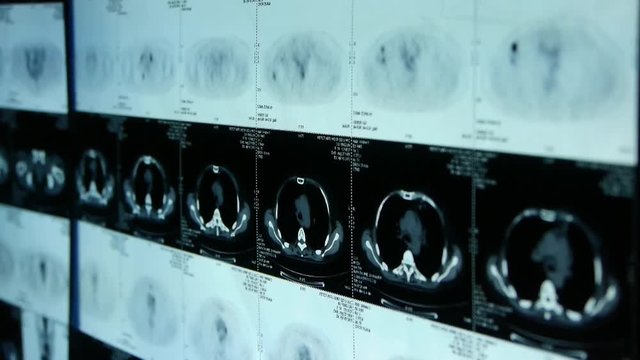 human orage pet-ct scan,medical X-ray,Cancer metastasis.