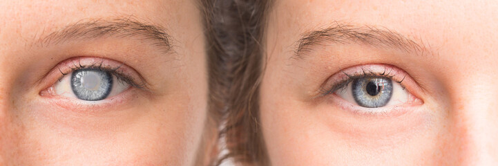 Female eyes before and after surgery with and without cataract