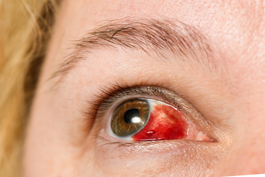 Subconjunctival hemorrhage - hyposphagma. Closeup of woman's face showing red bloodshot eye with browm iris, looked up and right