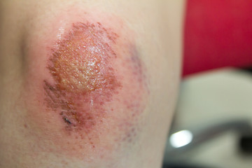Fototapeta premium Fresh wound with lymph and blood on asian female knee background