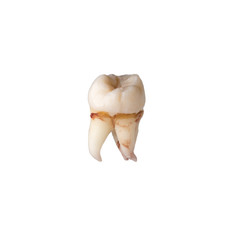 Extracted wisdom tooth, molar tooth