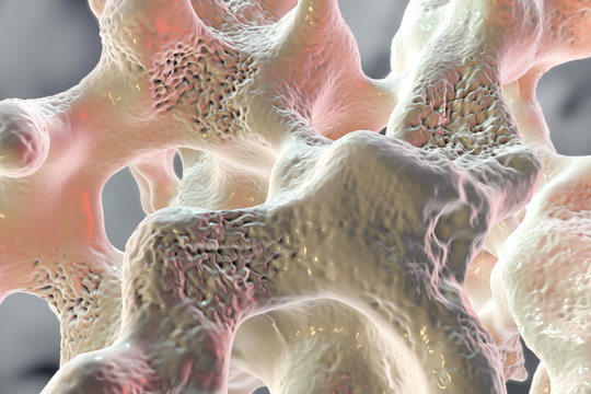 Spongy bone tissue affected by osteoporosis, 3D illustration