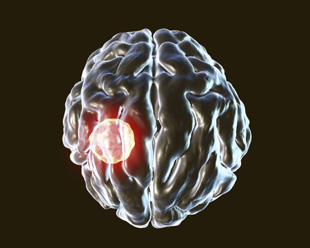 Brain abscess caused by parasitic protozoan Toxoplasma gondii, 3D illustration