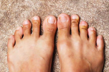 Foot, Rheumatoid foot disease background.