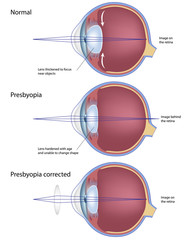 Eye condition: presbyopia