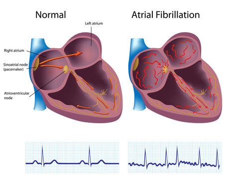 Atrial fibrillation - Afib or AF, conduction abnormality with ECG