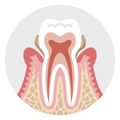 Middle stage Periodontal disease - Tooth cross section