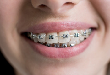 Close-up shot of teeth with braces. Smiling female patient with metal brackets at the dental...