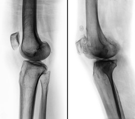 Comparison between normal human knee ( left image ) and osteoarthritis knee ( right image ) ....