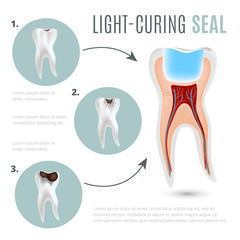 Realistic medical poster with stages of tooth decay and light-curing seal