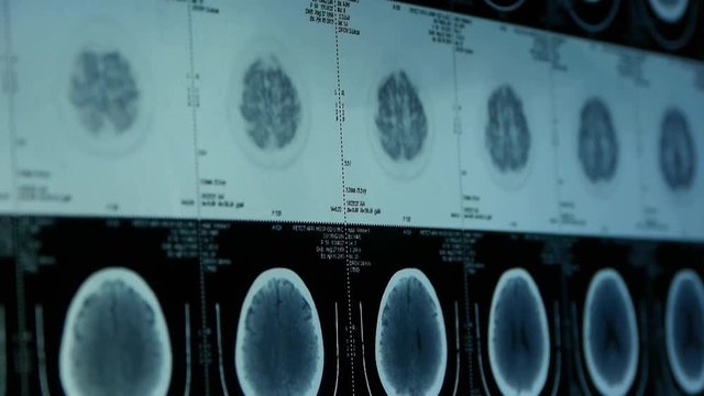 moving head pet cT scan,skull brain X-ray.	