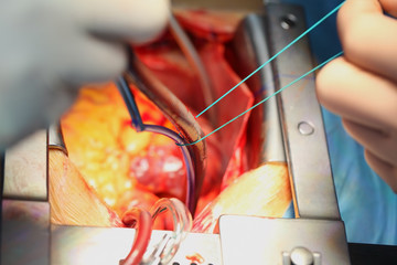 Process of cardiac surgical operation
