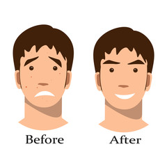 Boy acne treatment before and after