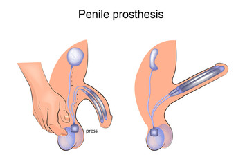 penile prosthesis. urology