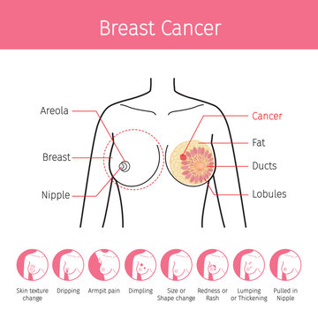 Illustration Of Female Human Breast, Outline And Breast Cancer Symptom Icons, Mammary, Boob, Body, Organs, Physical, Sickness, Health