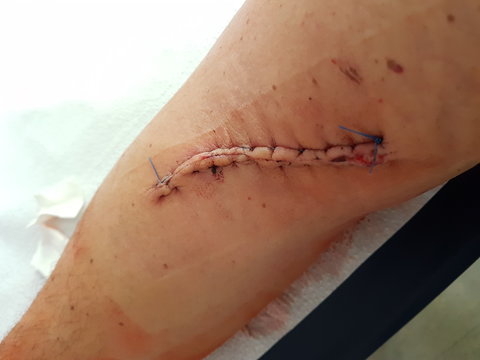 Medical stitches