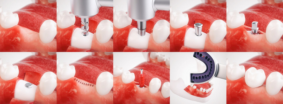Dental implant operation - 3D rendering

In this sequence of an implant operation you will see all the steps for using a dental implant. The pictures was created with the greatest possible care.
