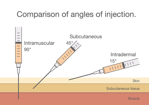 Comparison of the angles of intramuscular injection. Ideal for medical diagram about patient treatment.