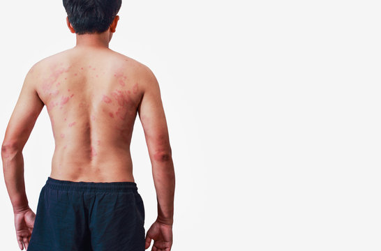 Around Back  Of Men With Dermatitis Problem Of Rash ,Allergy Rash